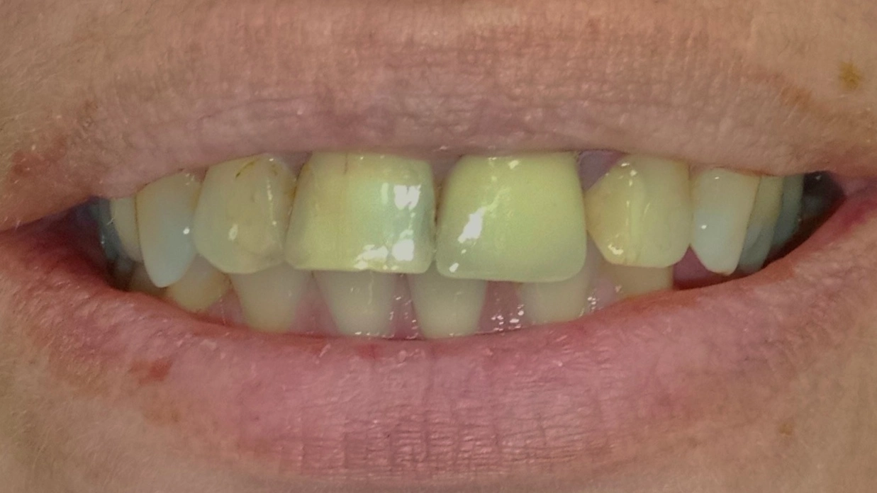 Pre Smile Makeover tretmana
