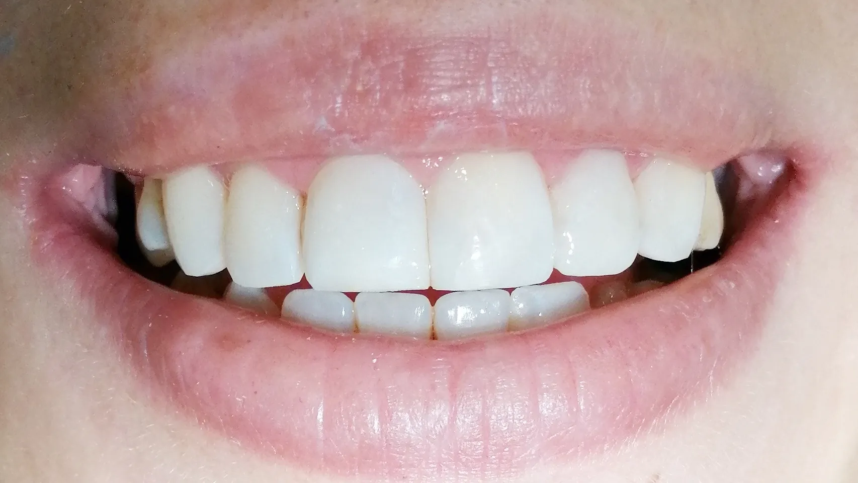 Posle faseta — savršen Hollywood smile